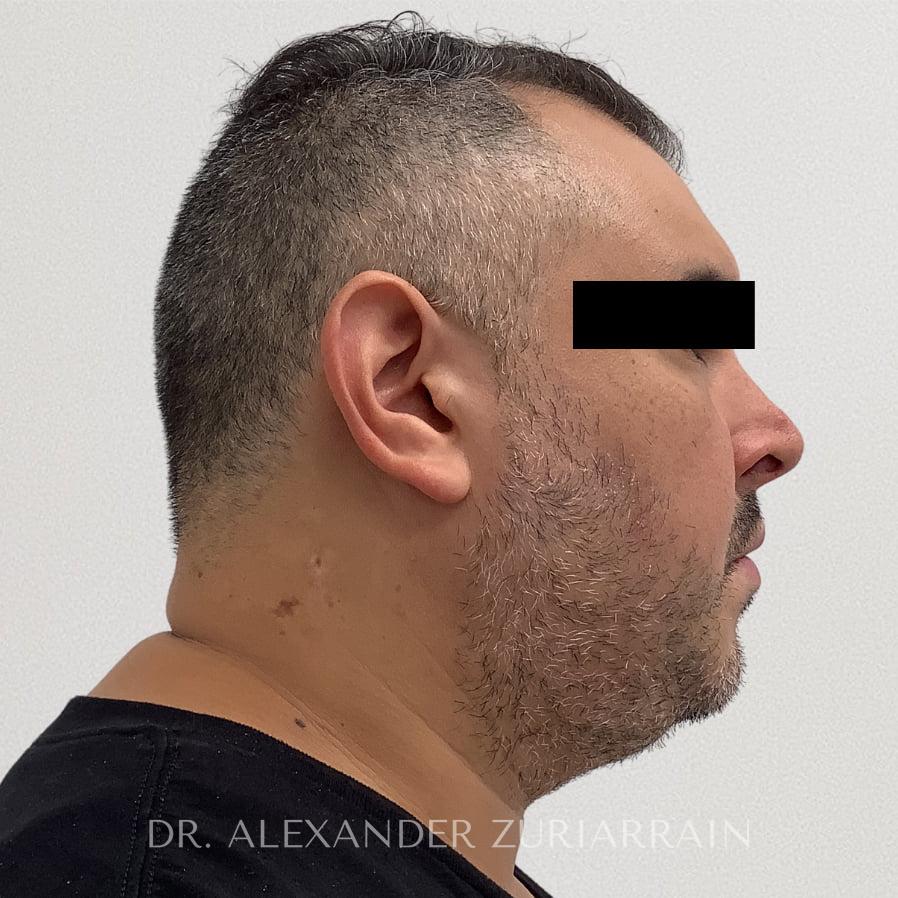 Chin implant before & after photo