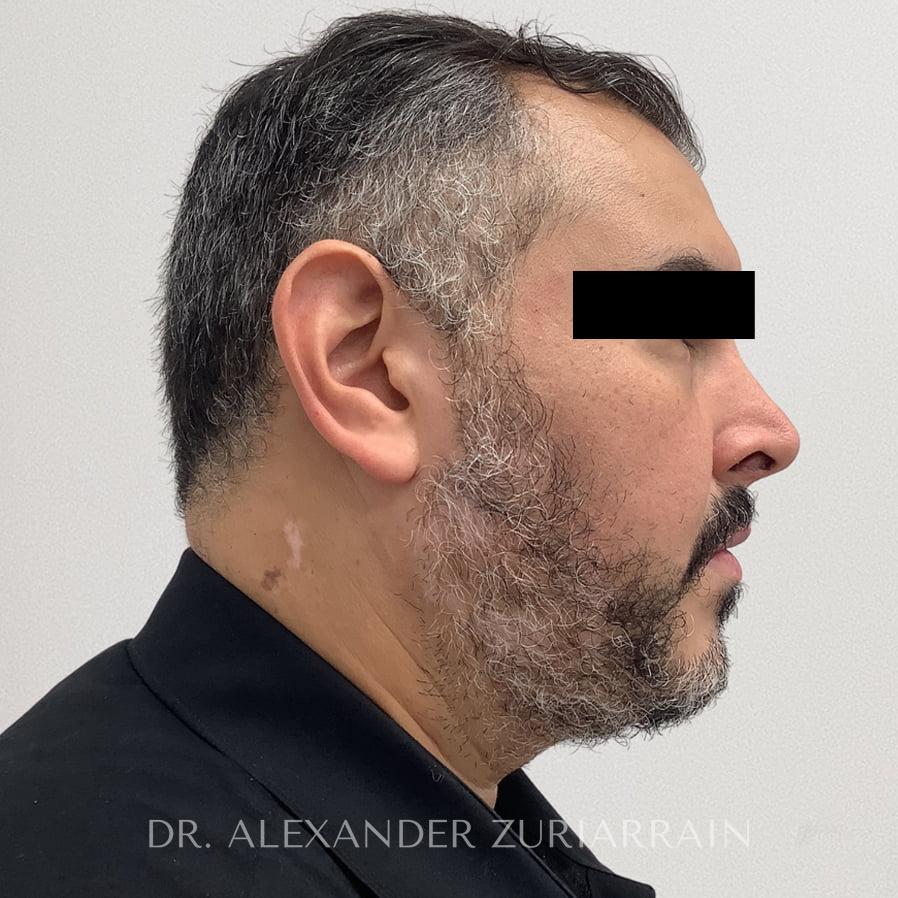 Chin implant before & after photo