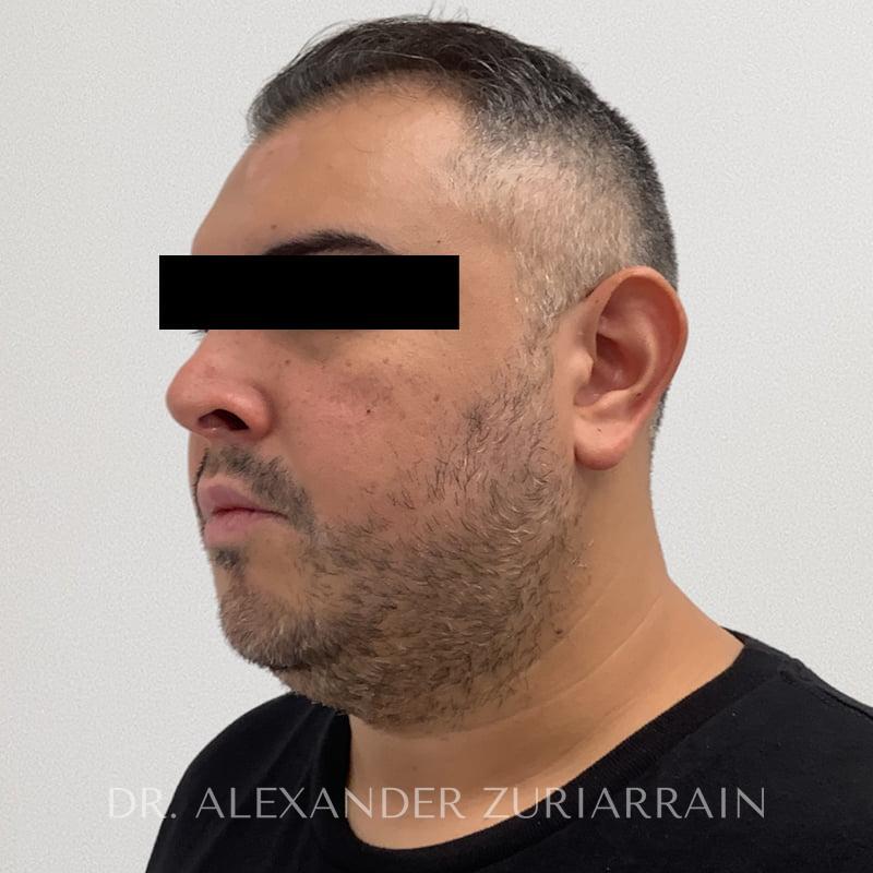 Chin implant before & after photo