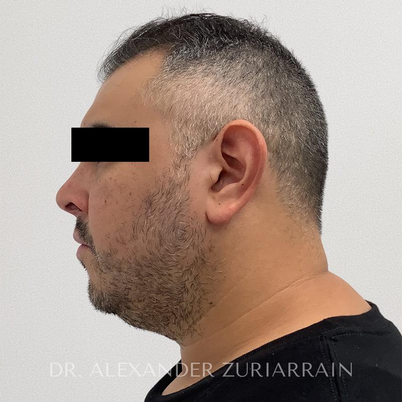 Chin implant before & after photo