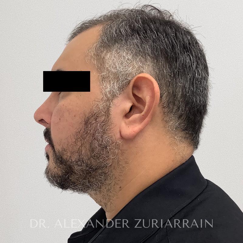 Chin implant before & after photo