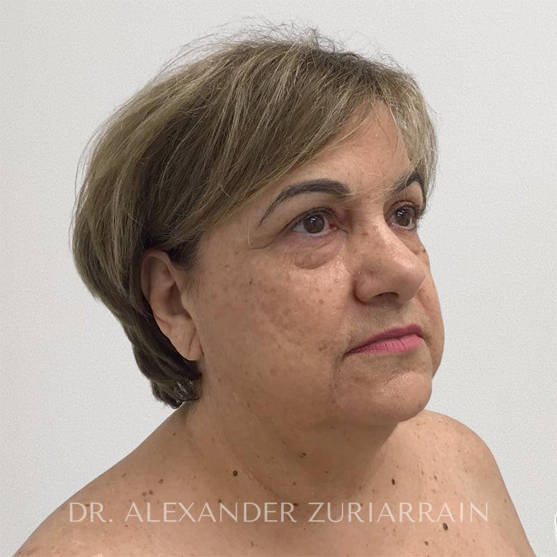 Facelift before & after photo