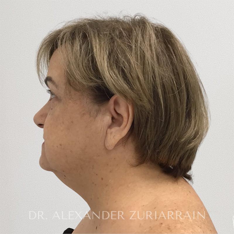 Facelift before & after photo