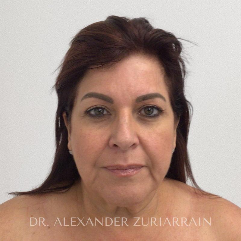 Facelift before & after photo