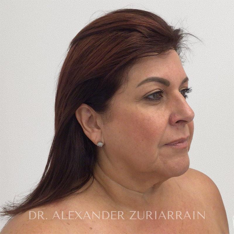 Facelift before & after photo