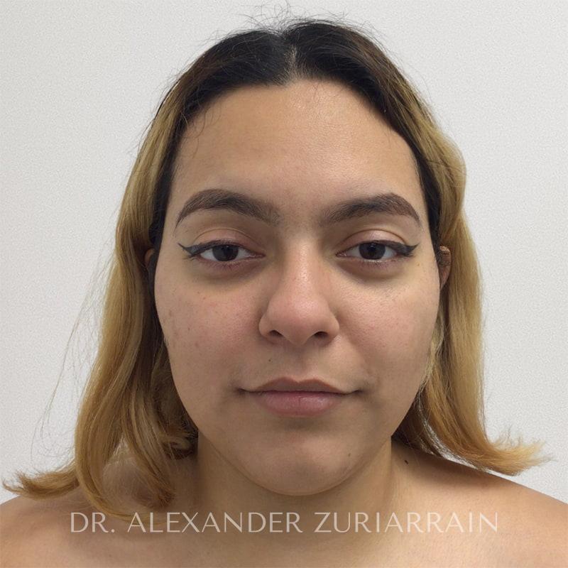 Facial liposuction before & after photo