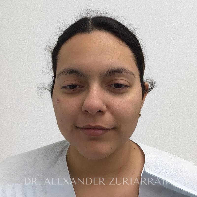 Facial liposuction before & after photo