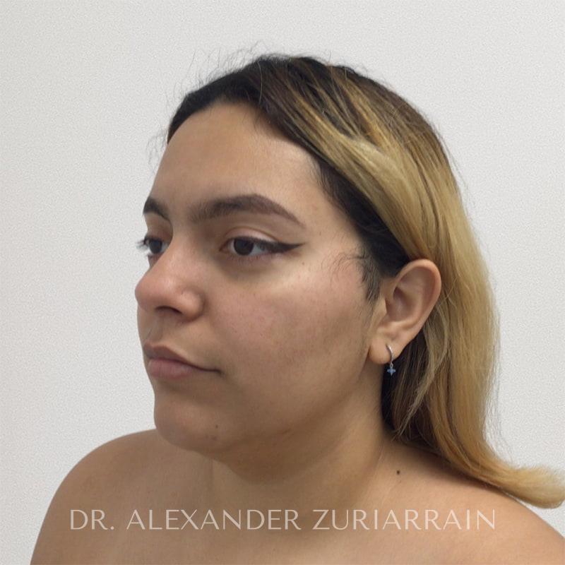 Facial liposuction before & after photo