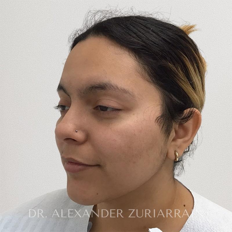 Facial liposuction before & after photo