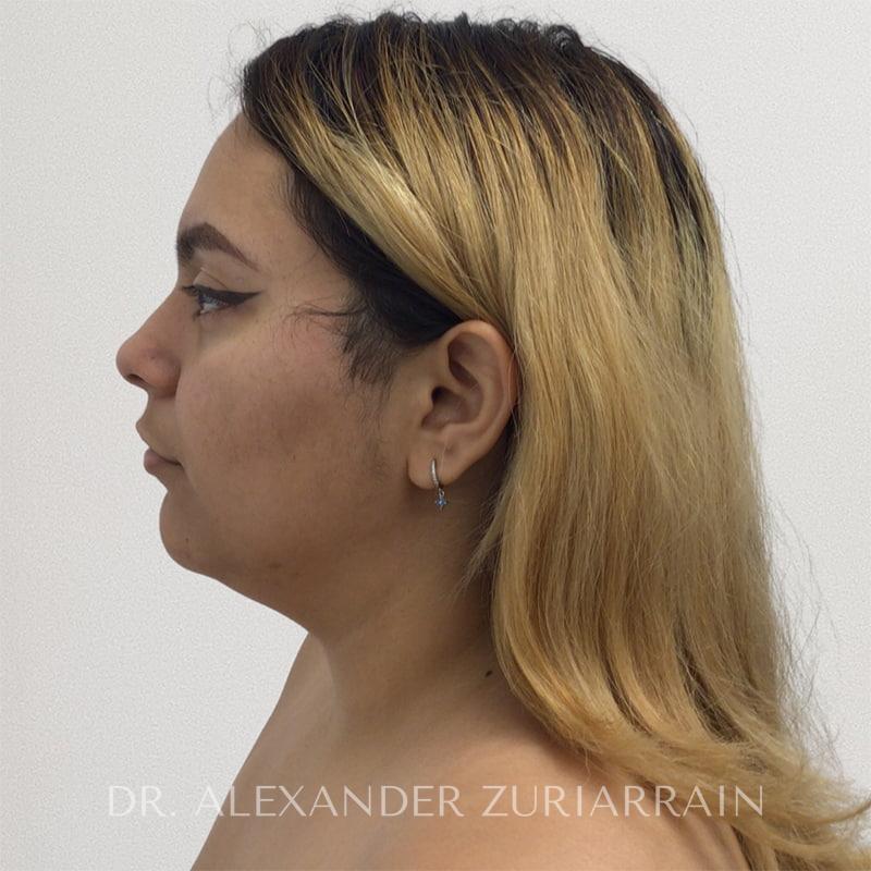 Facial liposuction before & after photo