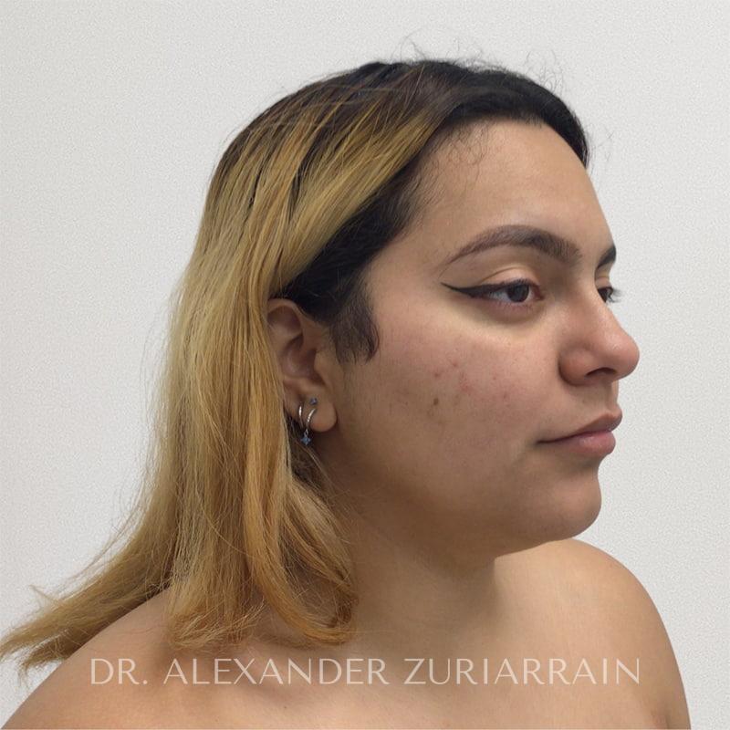 Facial liposuction before & after photo