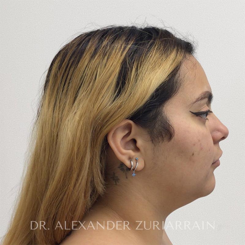 Facial liposuction before & after photo