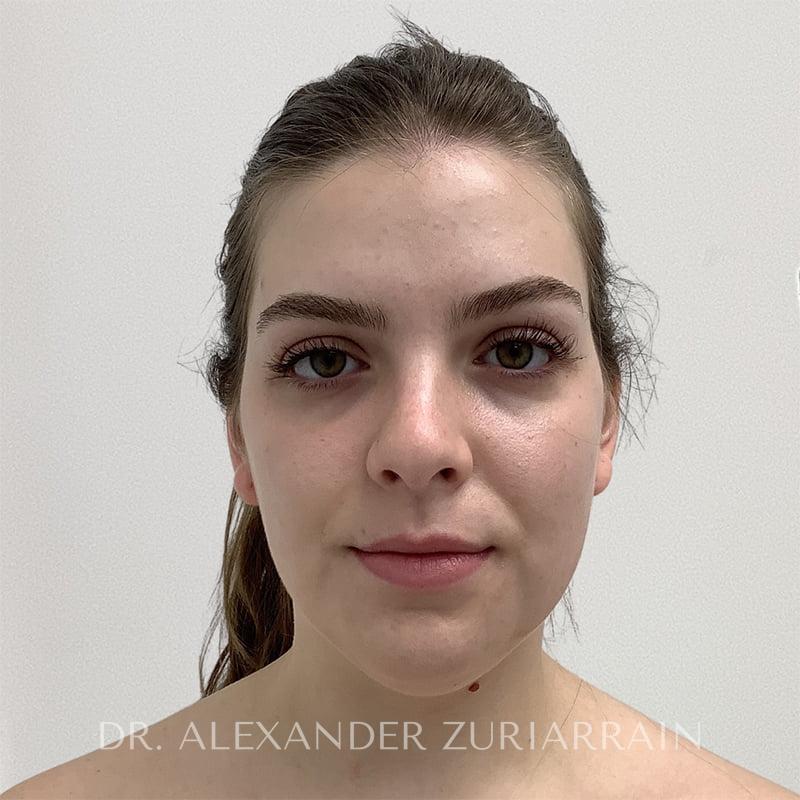 Facial liposuction before & after photo