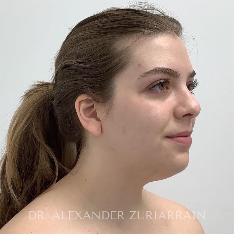 Facial liposuction before & after photo