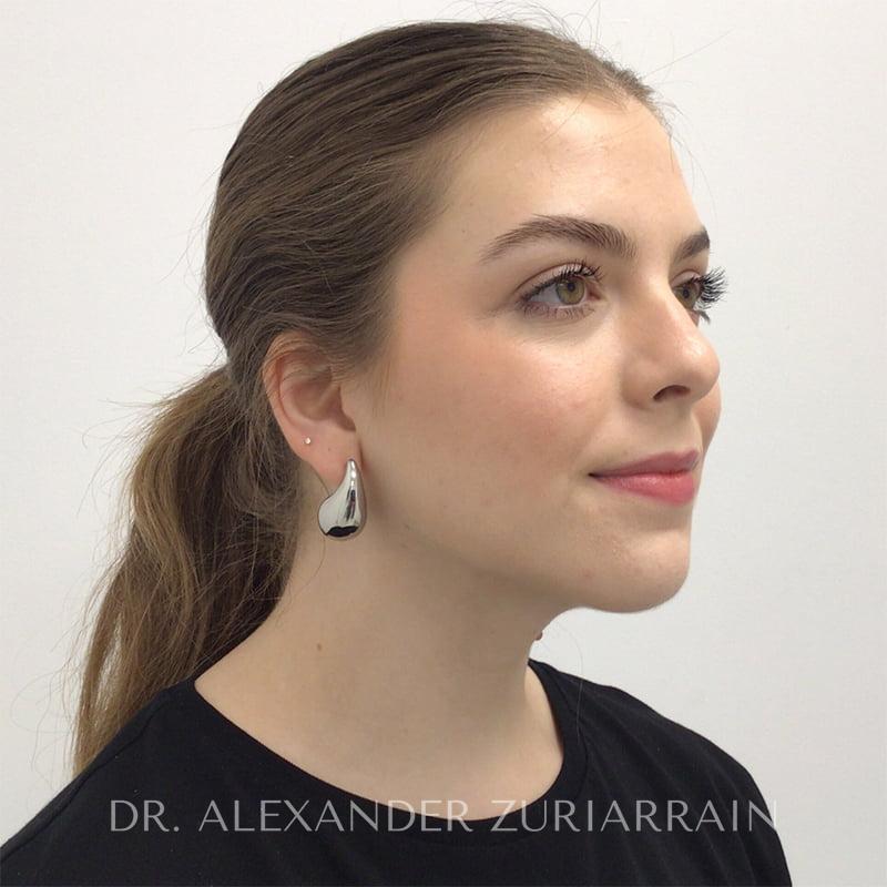 Facial liposuction before & after photo