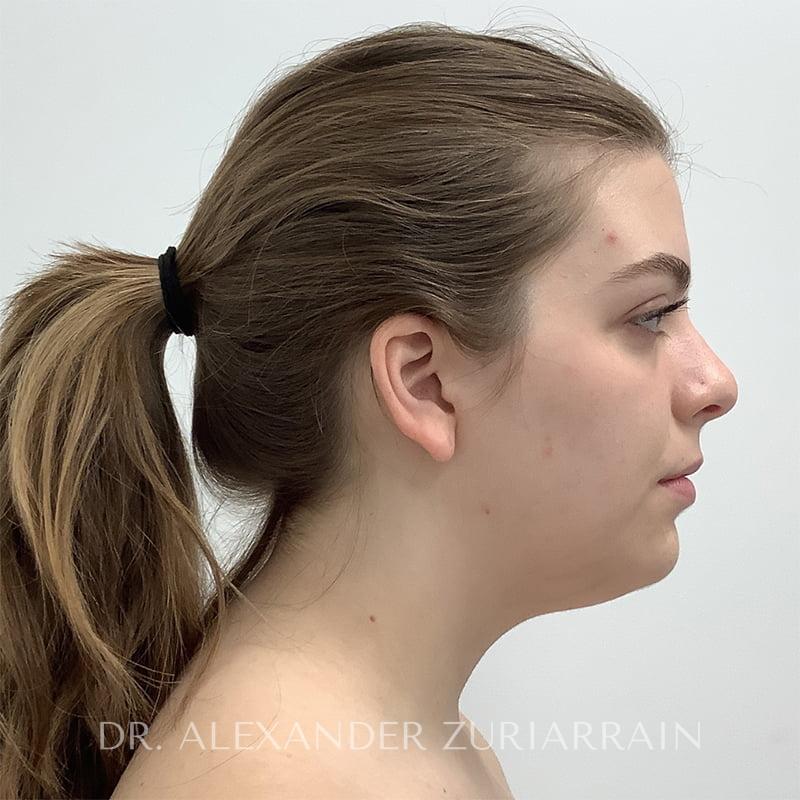 Facial liposuction before & after photo