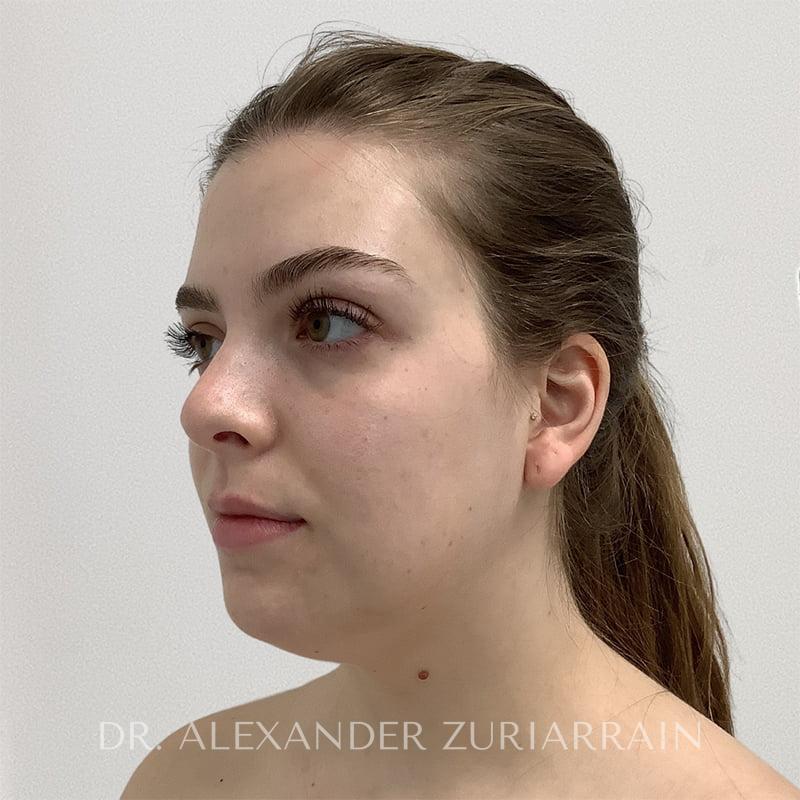 Facial liposuction before & after photo