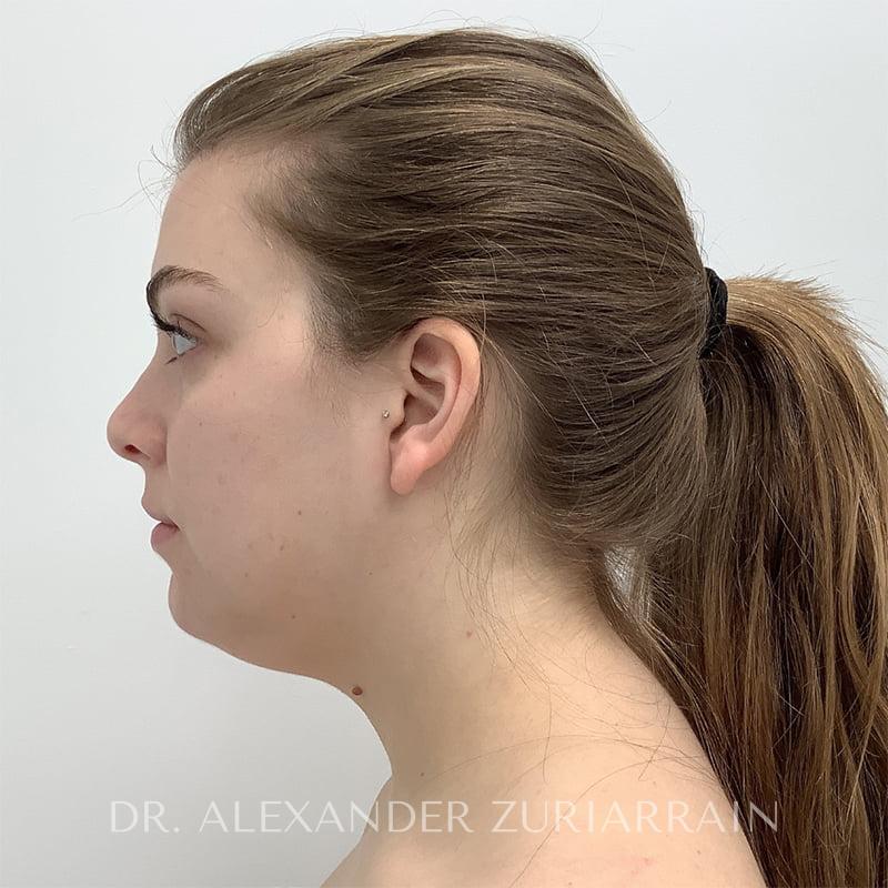 Facial liposuction before & after photo