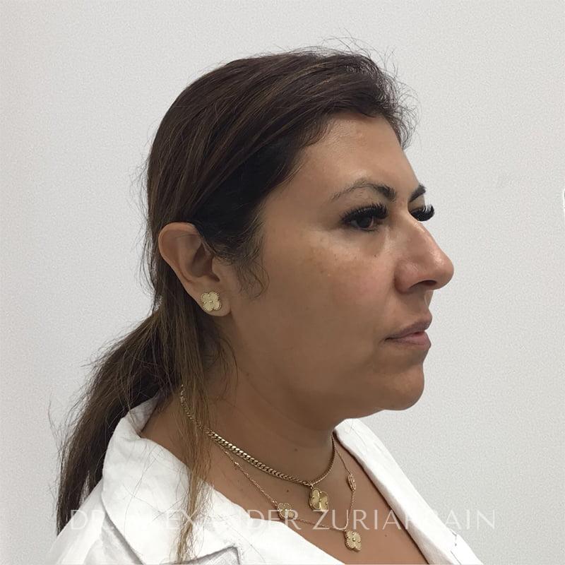 Facial liposuction before & after photo