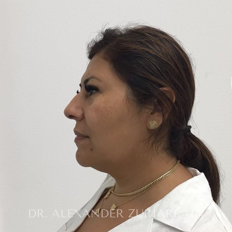 Facial liposuction before & after photo