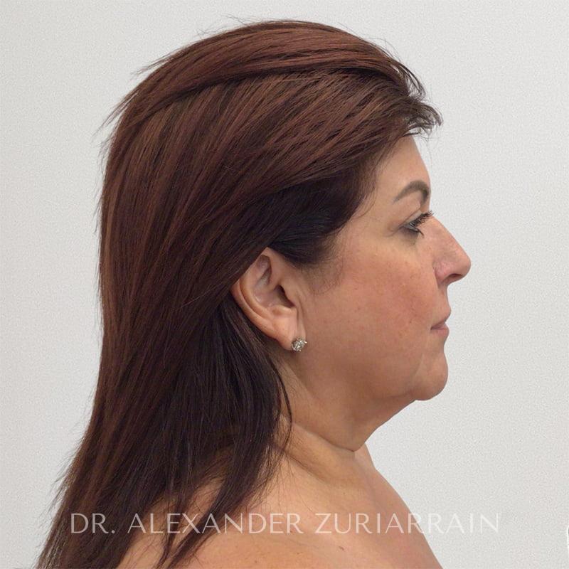 Neck lift before & after photo