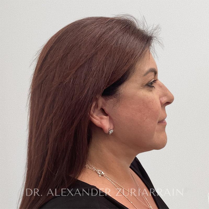 Neck lift before & after photo