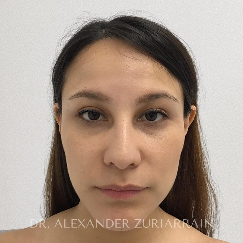 Rhinoplasty before & after photo