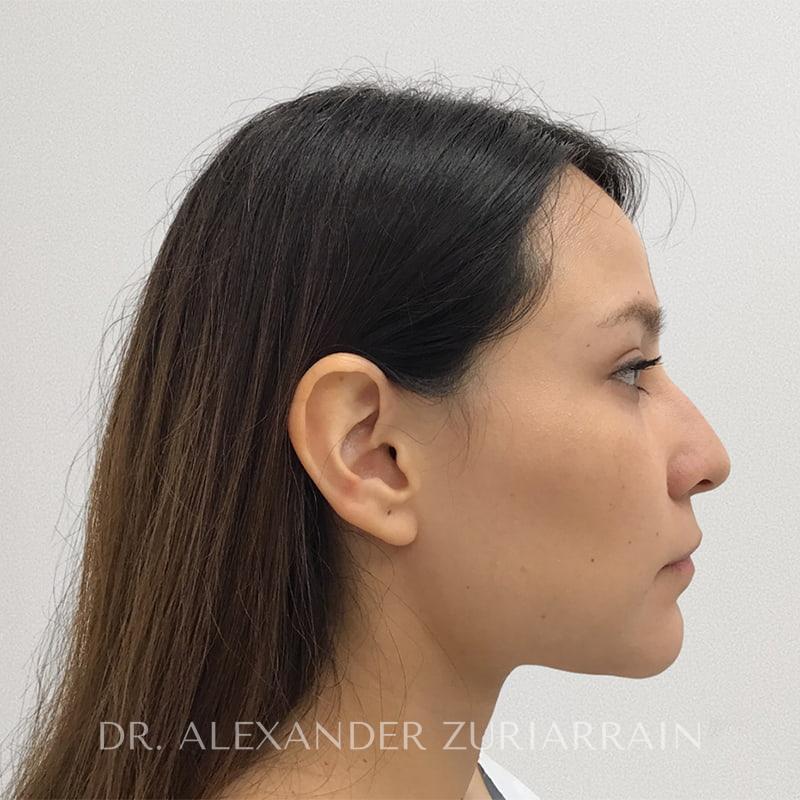 Rhinoplasty before & after photo