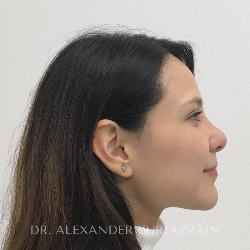 Rhinoplasty before & after photo