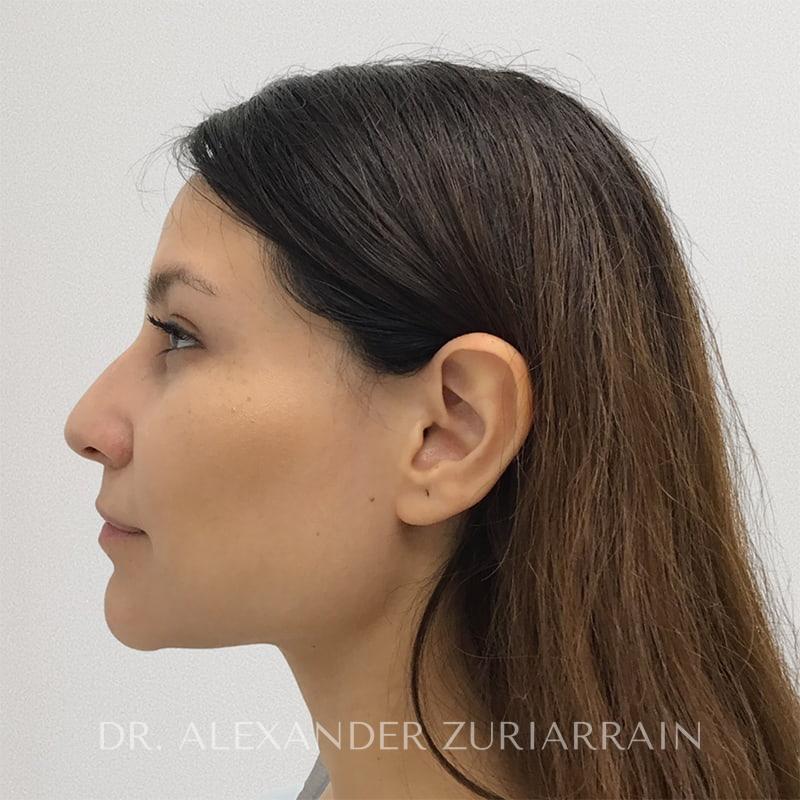 Rhinoplasty before & after photo