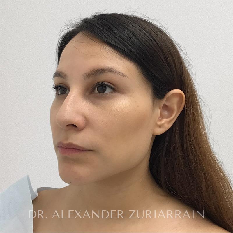 Rhinoplasty before & after photo